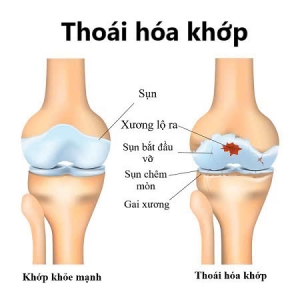 4 GIAI ĐOẠN CỦA THO&Aacute;I H&Oacute;A KHỚP