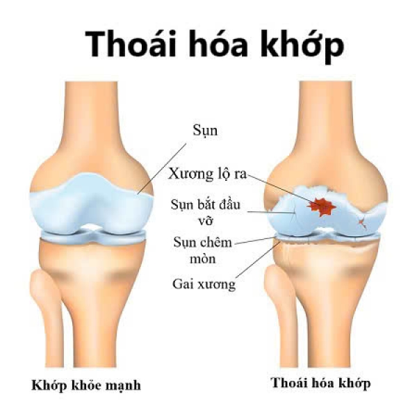 4 GIAI ĐOẠN CỦA THO&Aacute;I H&Oacute;A KHỚP