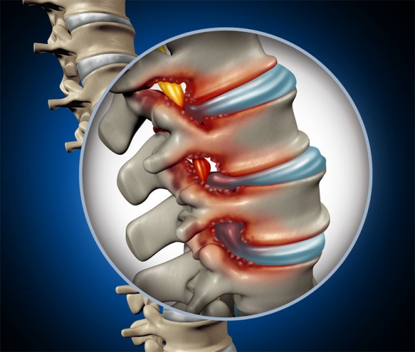 THO&Aacute;T VỊ ĐĨA ĐỆM C&Oacute; TỰ KHỎI ĐƯỢC KH&Ocirc;NG?