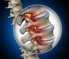 THO&Aacute;T VỊ ĐĨA ĐỆM C&Oacute; TỰ KHỎI ĐƯỢC KH&Ocirc;NG?