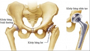THAY KHỚP H&Aacute;NG NH&Acirc;N TẠO &ndash; BAO L&Acirc;U C&Oacute; THỂ ĐI LẠI?