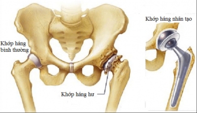 THAY KHỚP H&Aacute;NG NH&Acirc;N TẠO &ndash; BAO L&Acirc;U C&Oacute; THỂ ĐI LẠI?