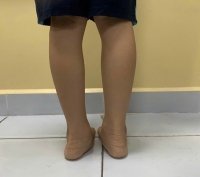 NGHI NGỜ TRẺ BỊ B&Agrave;N CH&Acirc;N BẸT? KIẾN THỨC QUAN TRỌNG BA MẸ CẦN PHẢI BIẾT
