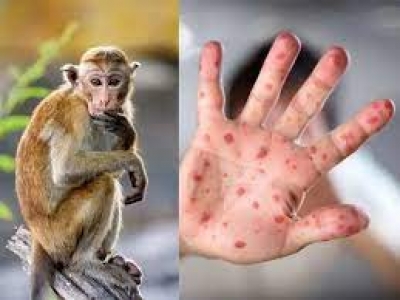 🐵BỆNH ĐẬU M&Ugrave;A KHỈ V&Agrave; C&Aacute;C BIỆN PH&Aacute;P PH&Ograve;NG TR&Aacute;NH🦠🦠🦠 ❗