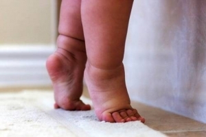 TẬT NH&Oacute;N CH&Acirc;N V&Ocirc; CĂN Ở TRẺ EM